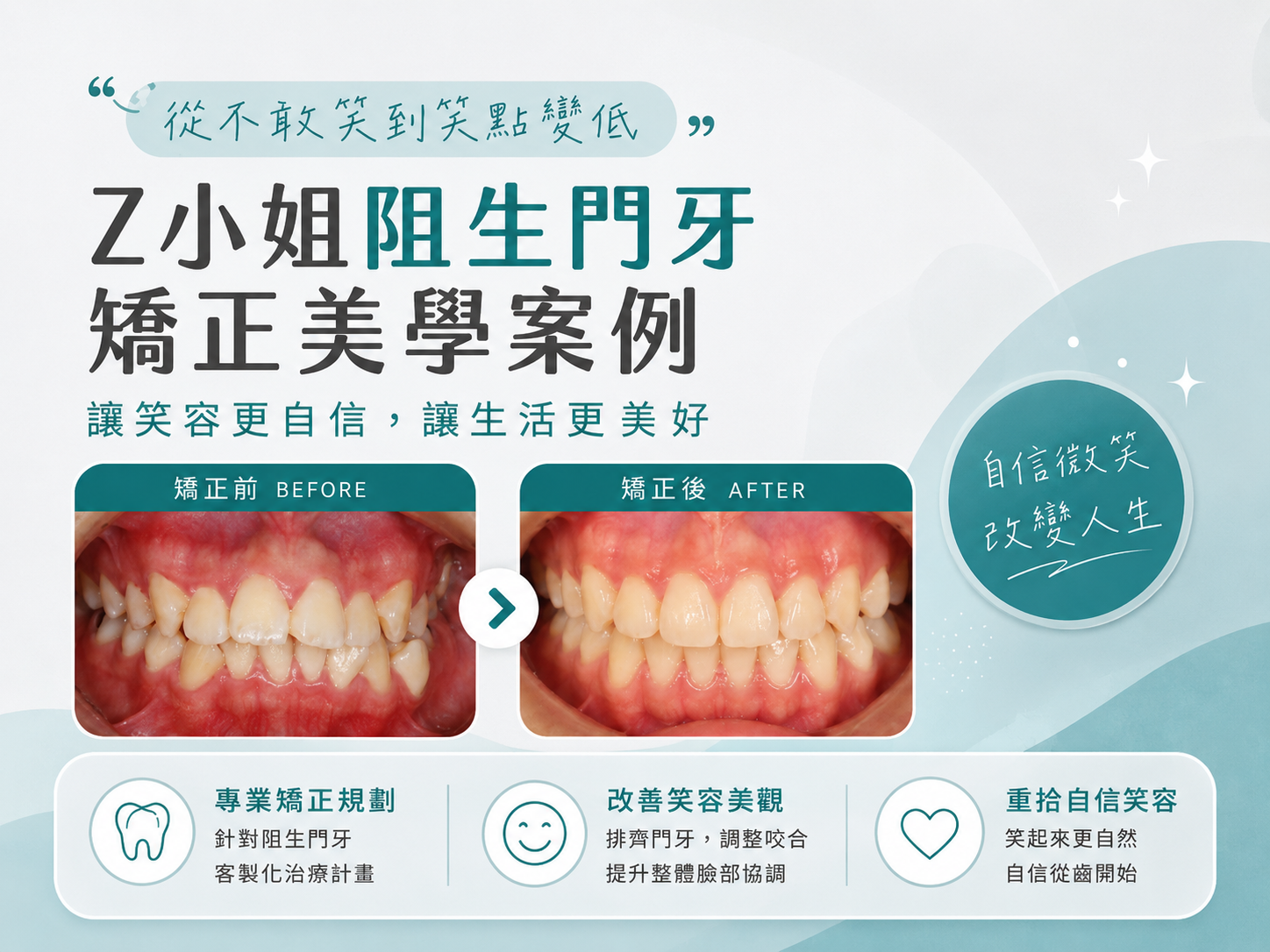 從不敢笑到笑點變低｜Z小姐阻生門牙矯正美學案例