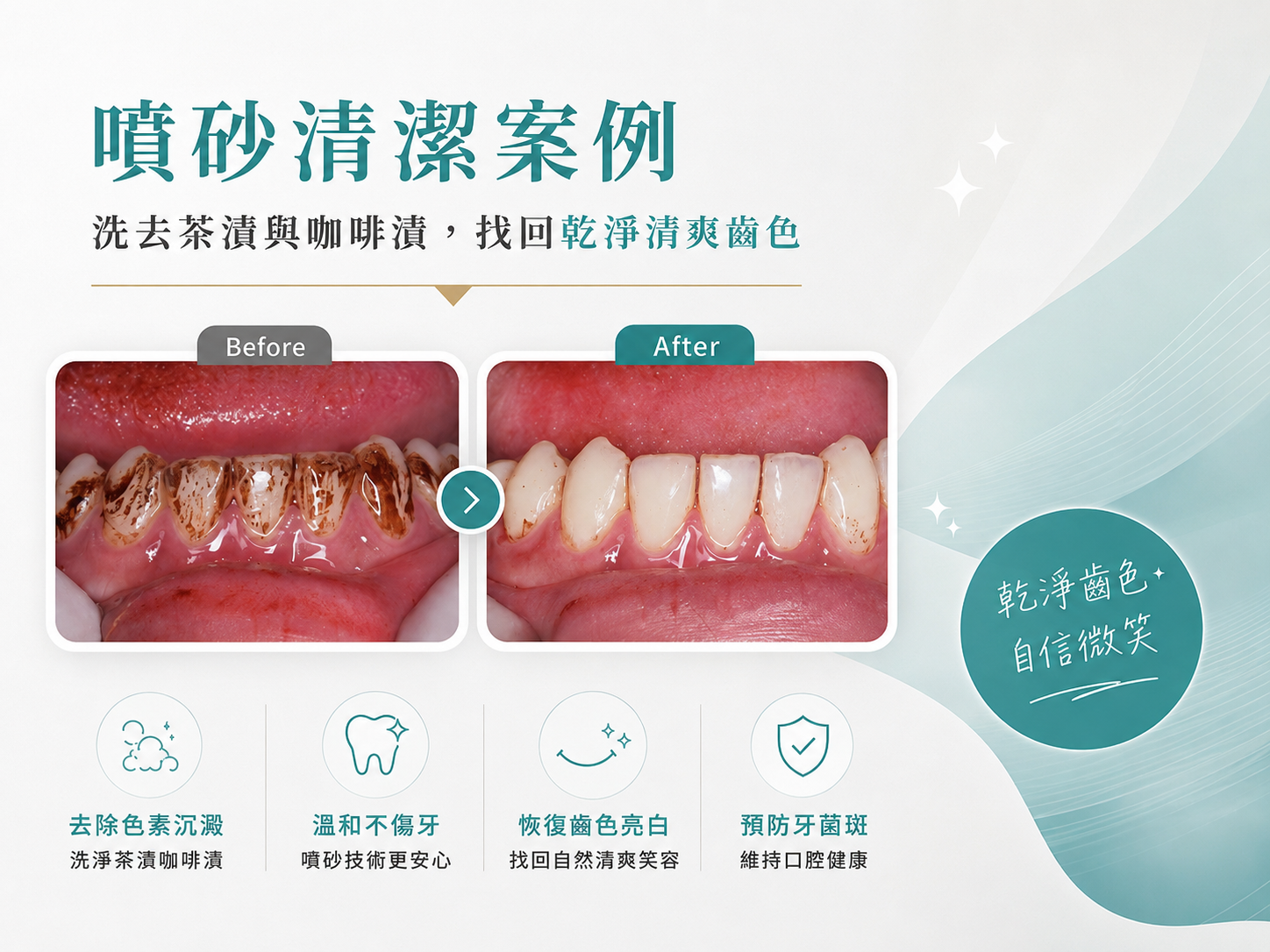 噴砂清潔案例｜洗去茶漬與咖啡漬，找回乾淨清爽齒色