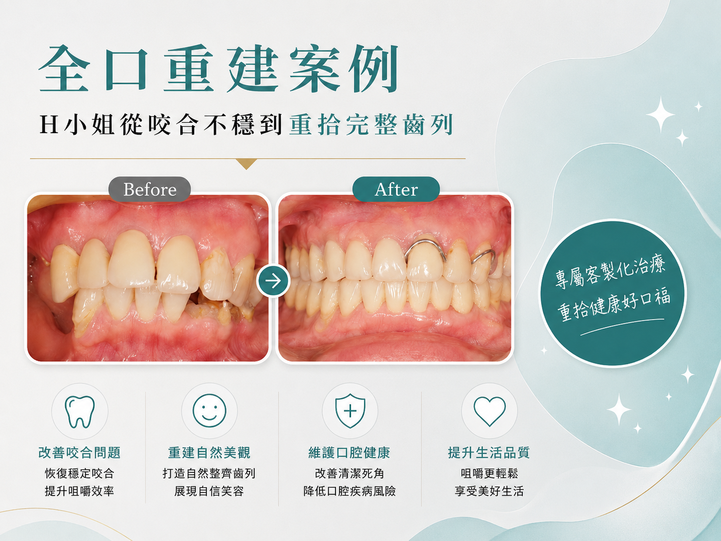 全口重建案例｜H小姐從咬合不穩到重拾完整齒列