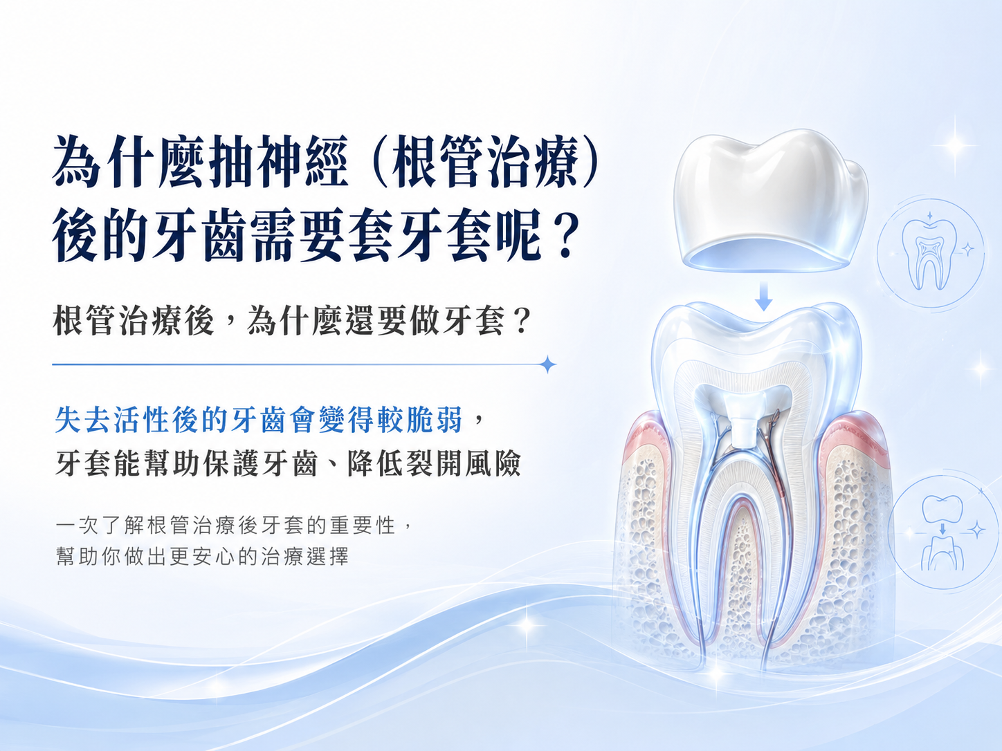 為什麼抽神經（根管治療）後的牙齒需要套牙套呢？